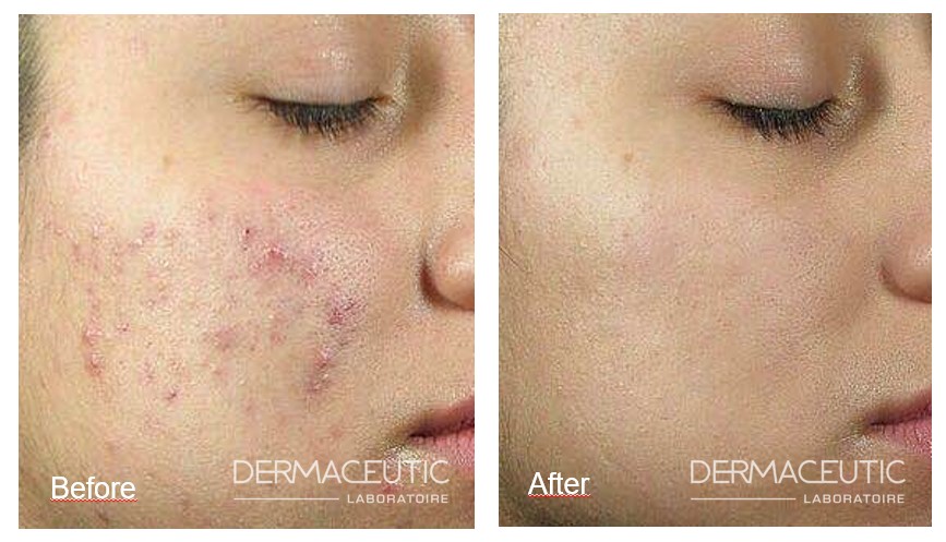 kemisk peeling kemisk peeling